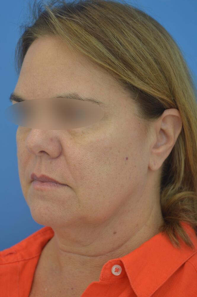 Face and neck lift Before & After Image