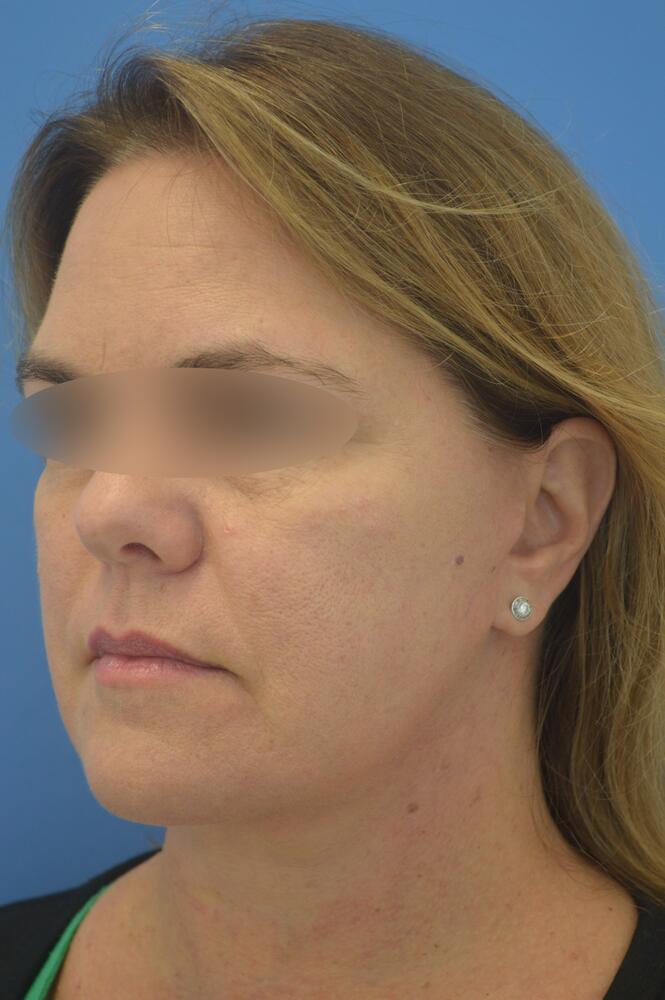 Face and neck lift Before & After Image