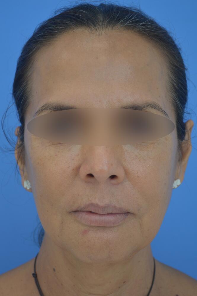 Face and neck lift Before & After Image