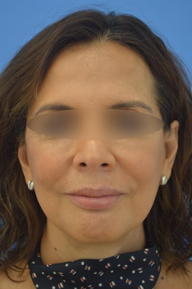 Face and neck lift Before & After Image