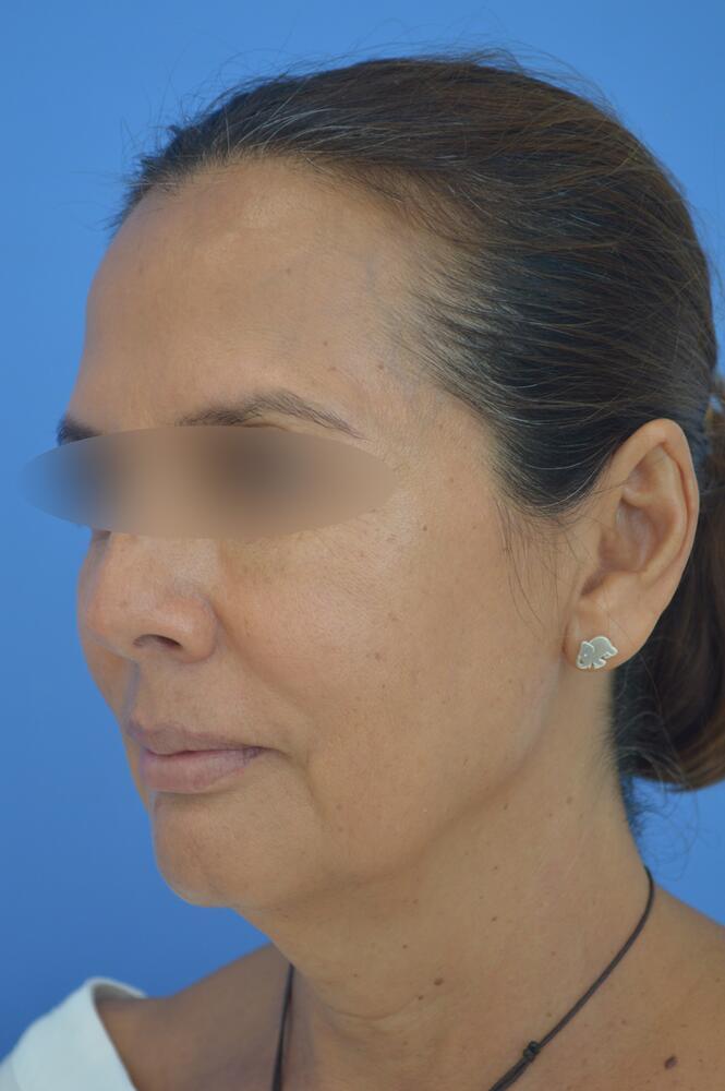 Face and neck lift Before & After Image