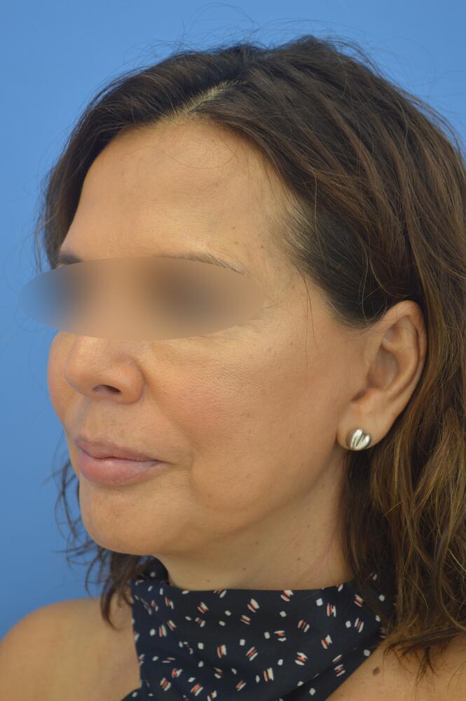 Face and neck lift Before & After Image
