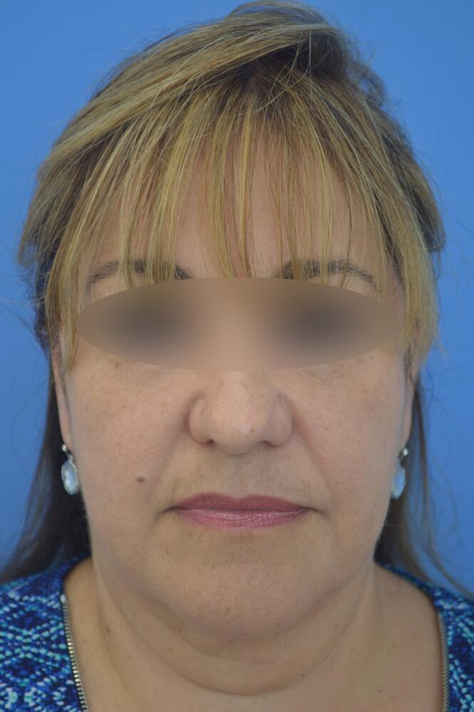 Face and neck lift Before & After Image