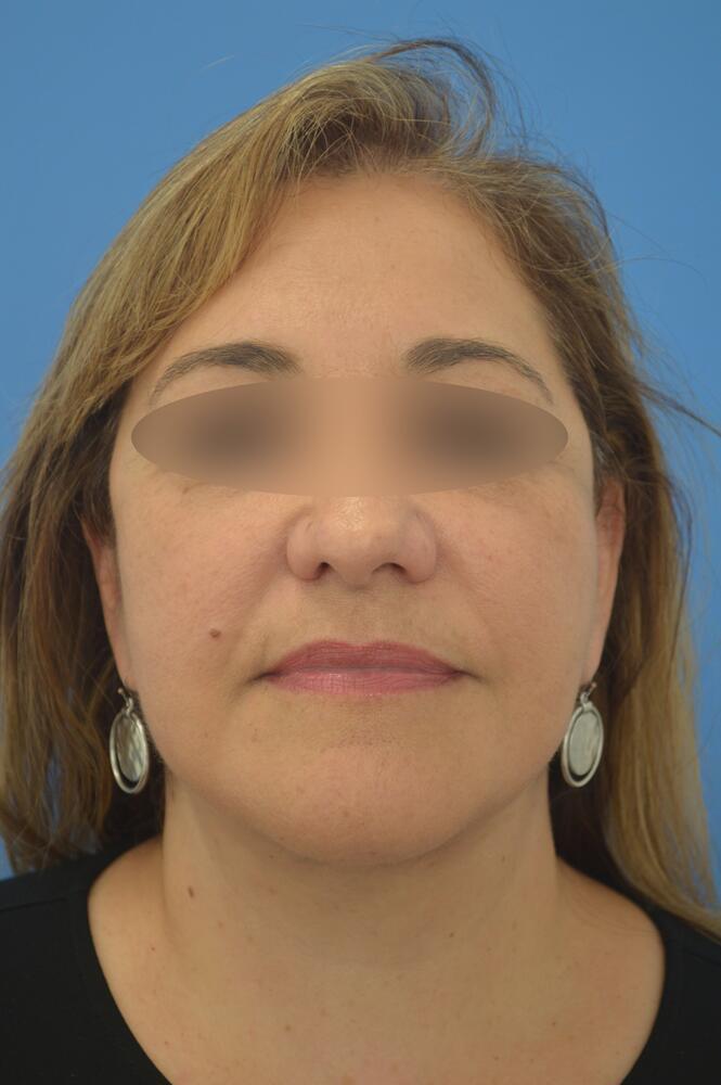 Face and neck lift Before & After Image