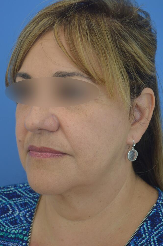 Face and neck lift Before & After Image