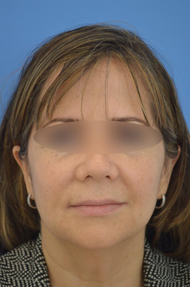 Face and neck lift Before & After Image