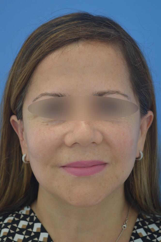 Face and neck lift Before & After Image