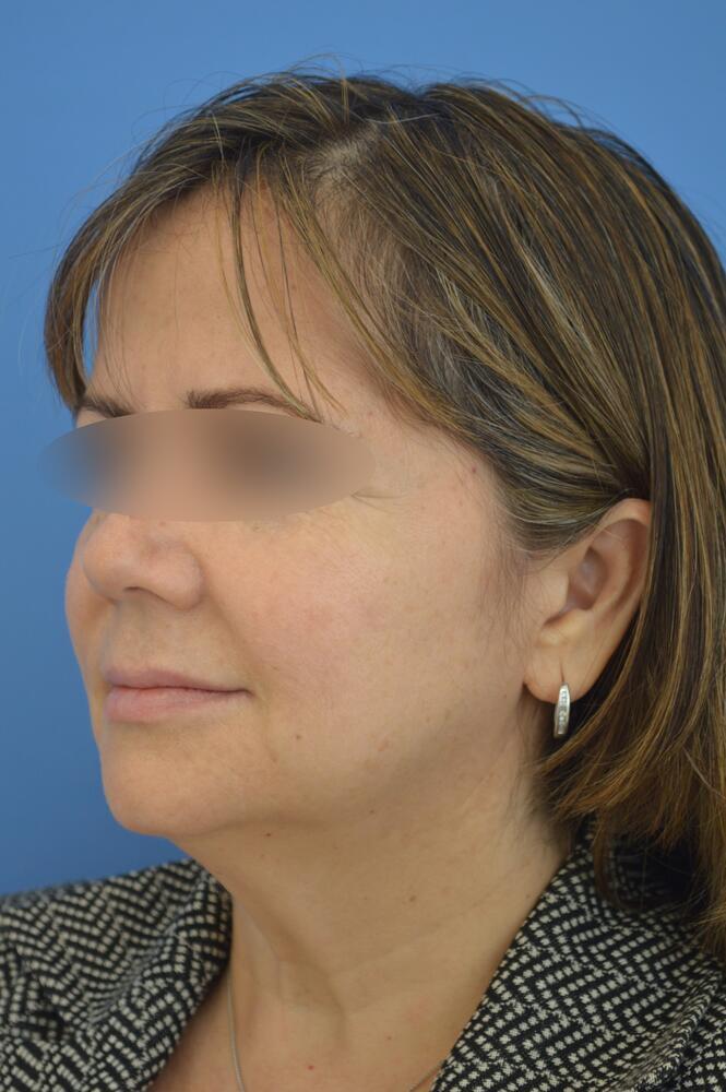 Face and neck lift Before & After Image