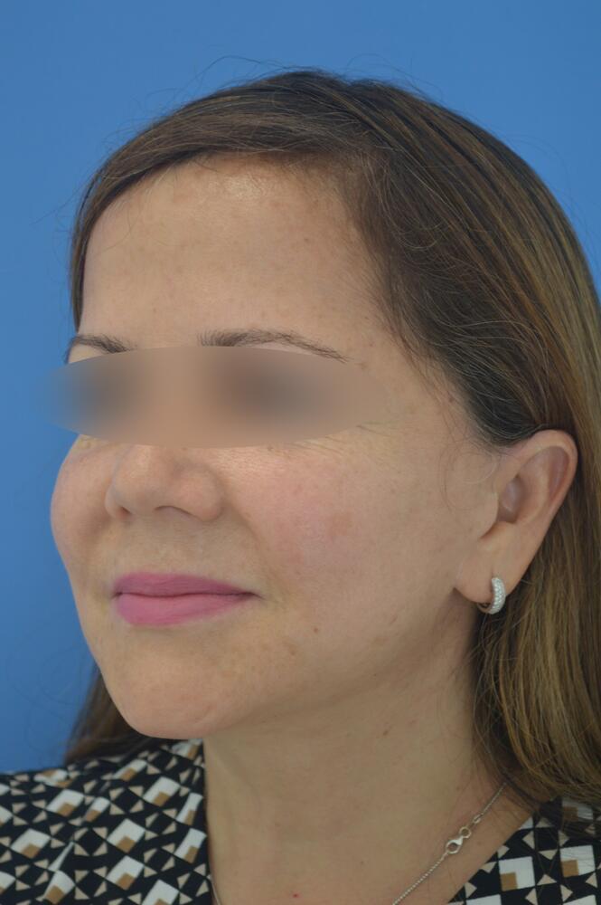 Face and neck lift Before & After Image