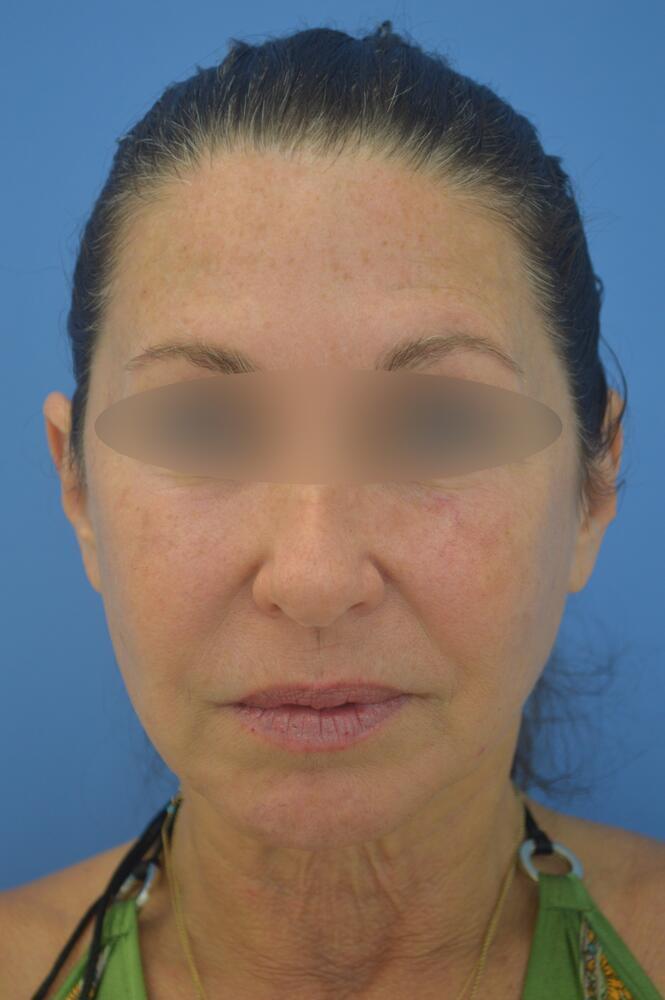 Face and neck lift Before & After Image