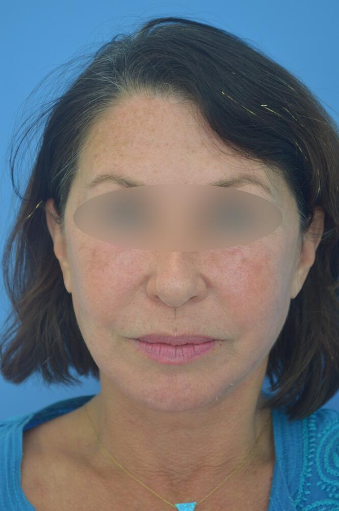 Face and neck lift Before & After Image