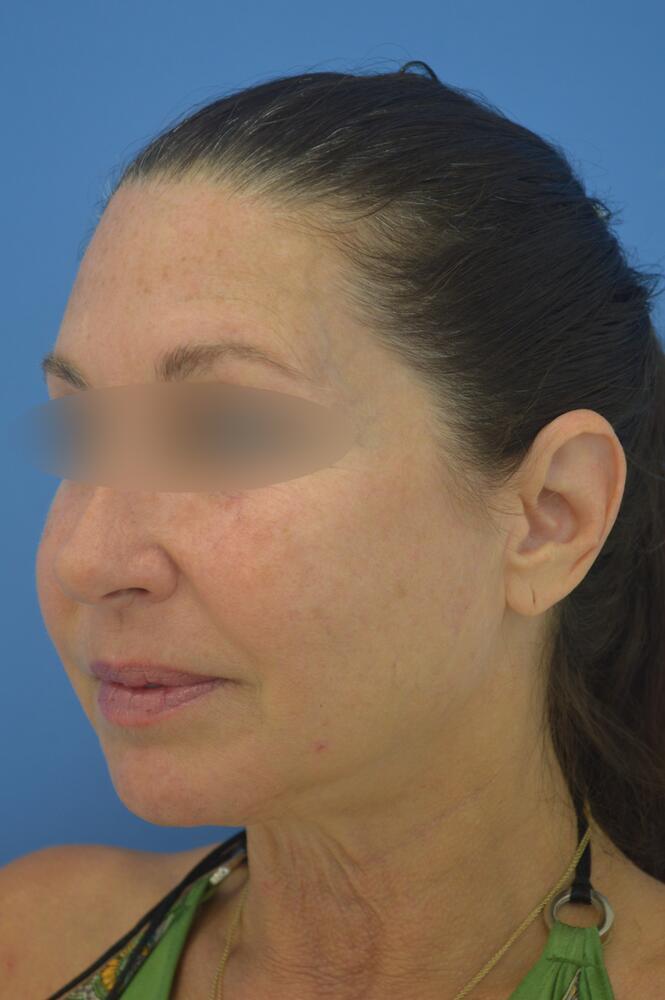 Face and neck lift Before & After Image