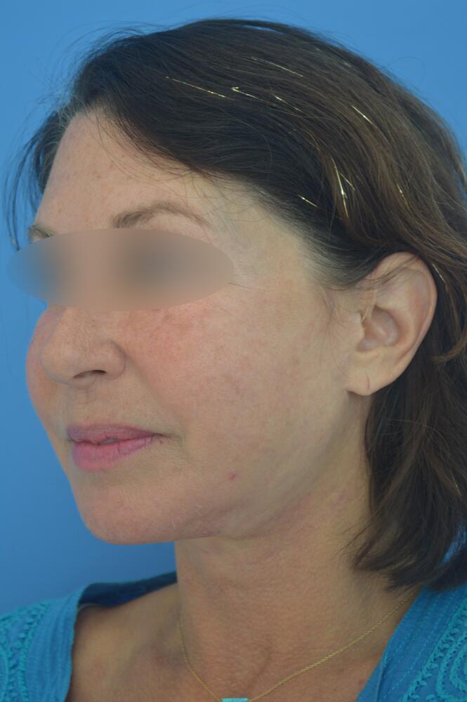 Face and neck lift Before & After Image