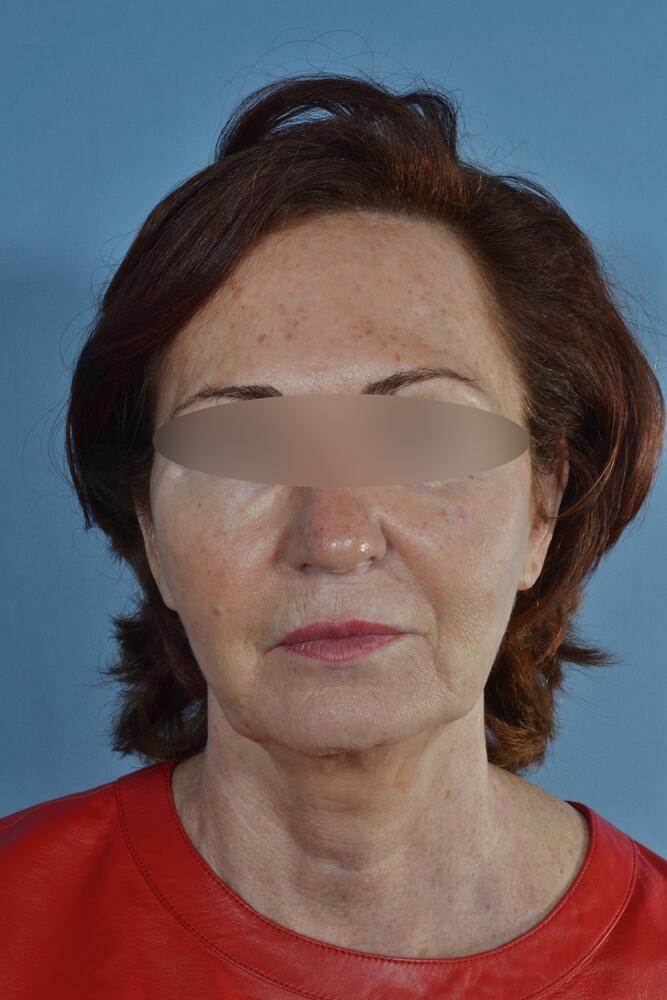 Face and neck lift Before & After Image