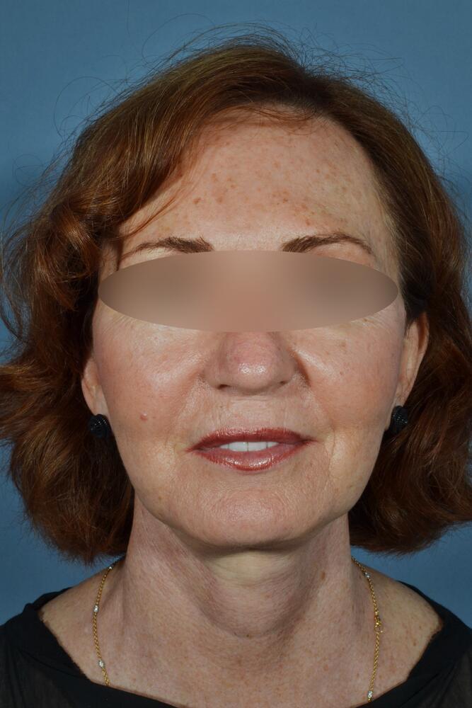 Face and neck lift Before & After Image