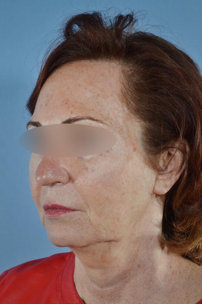 Face and neck lift Before & After Image