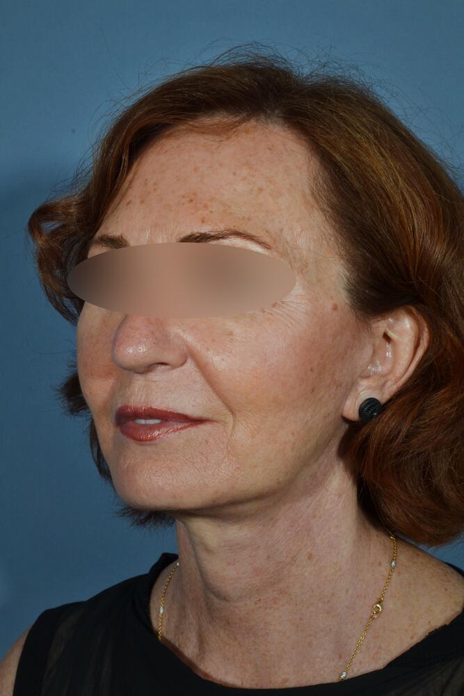 Face and neck lift Before & After Image
