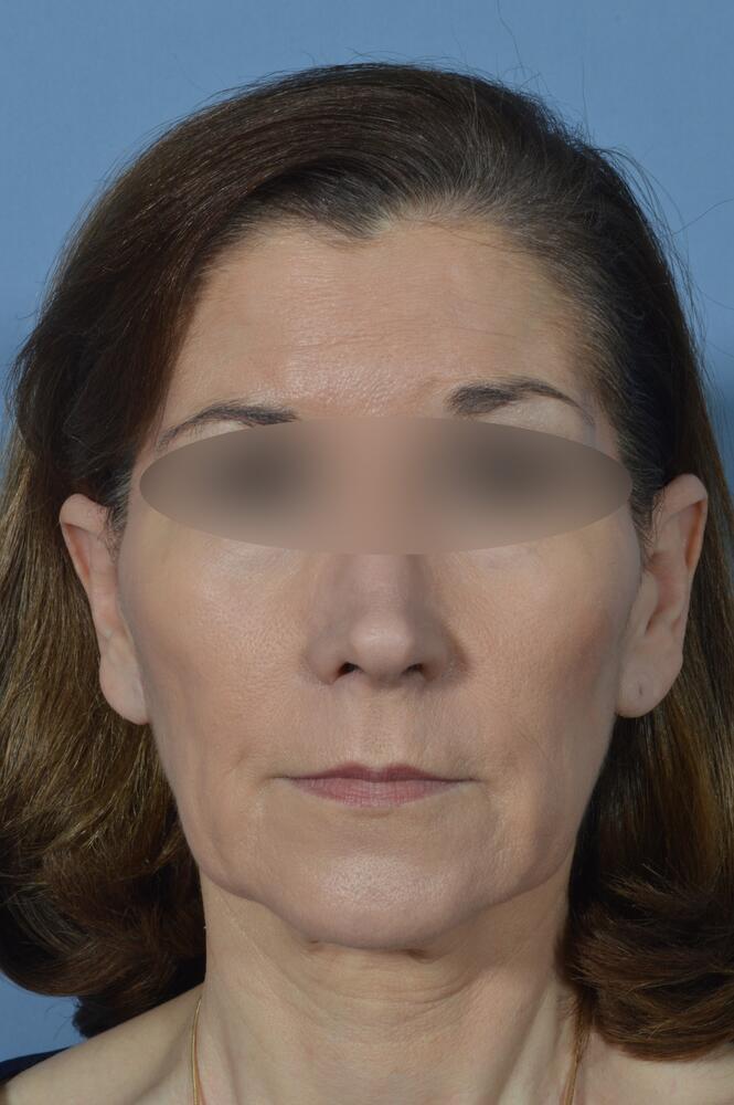 Face and neck lift Before & After Image