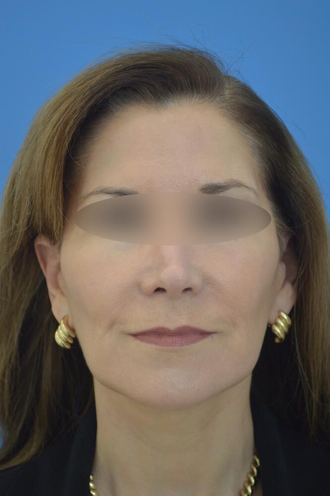 Face and neck lift Before & After Image