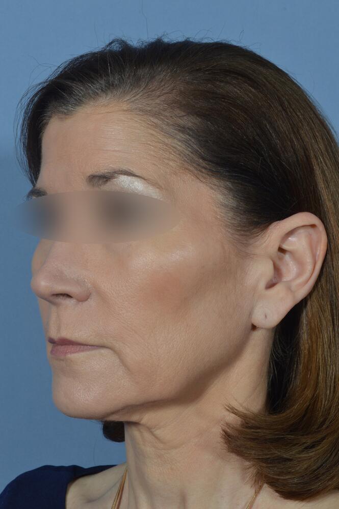 Face and neck lift Before & After Image