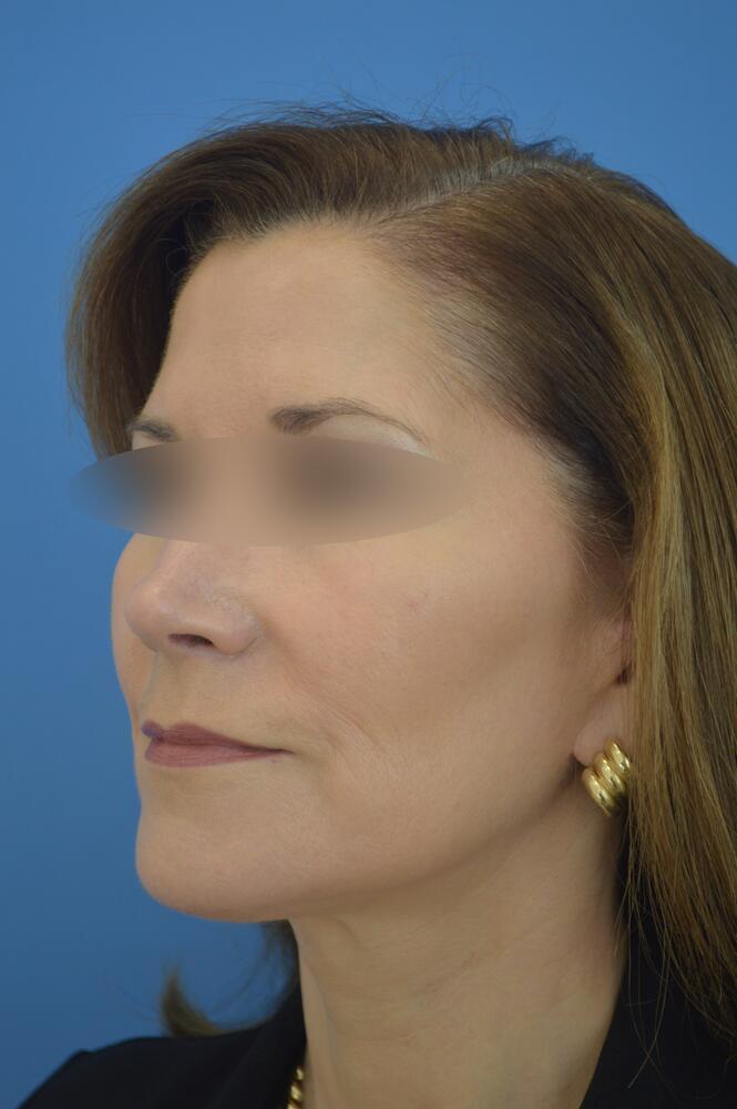 Face and neck lift Before & After Image