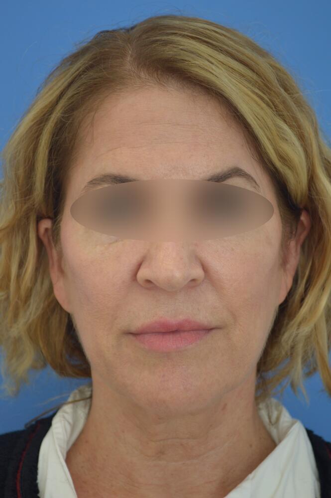 Face and neck lift Before & After Image