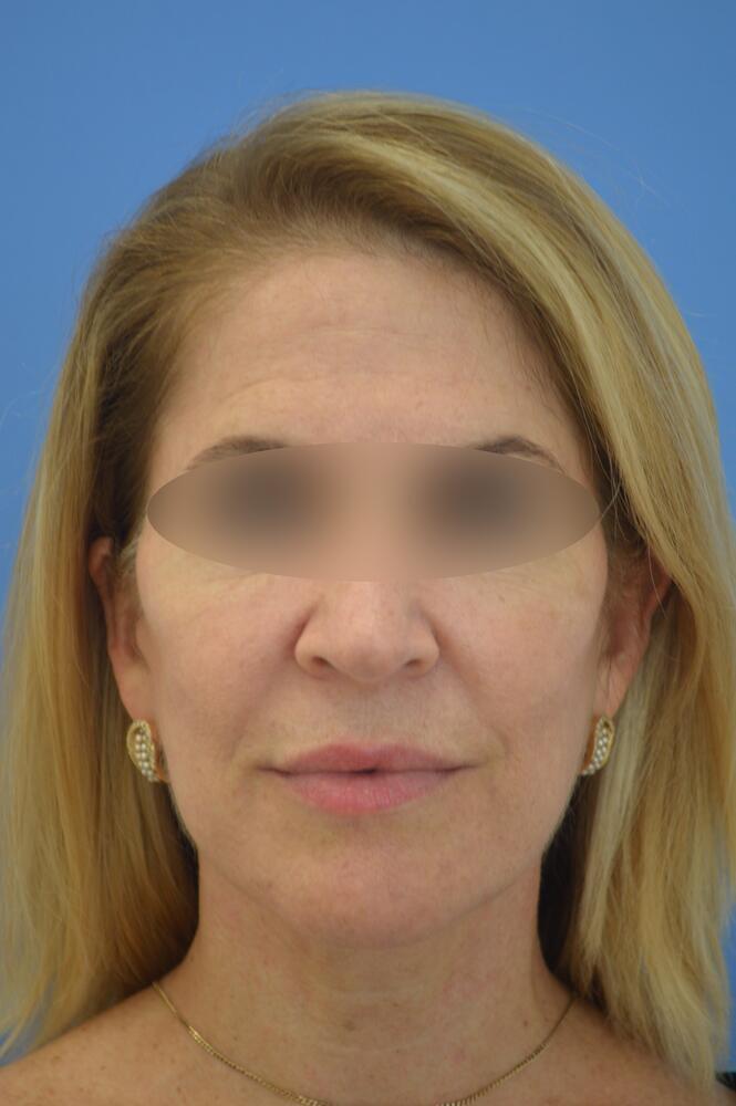 Face and neck lift Before & After Image