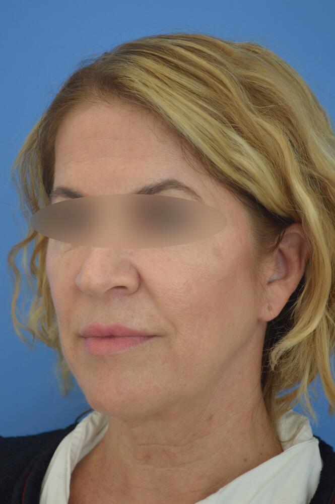 Face and neck lift Before & After Image