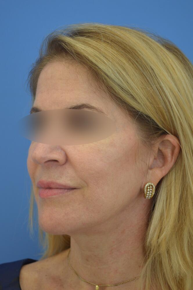 Face and neck lift Before & After Image