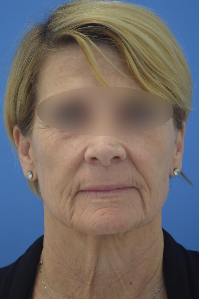 Face and neck lift Before & After Image