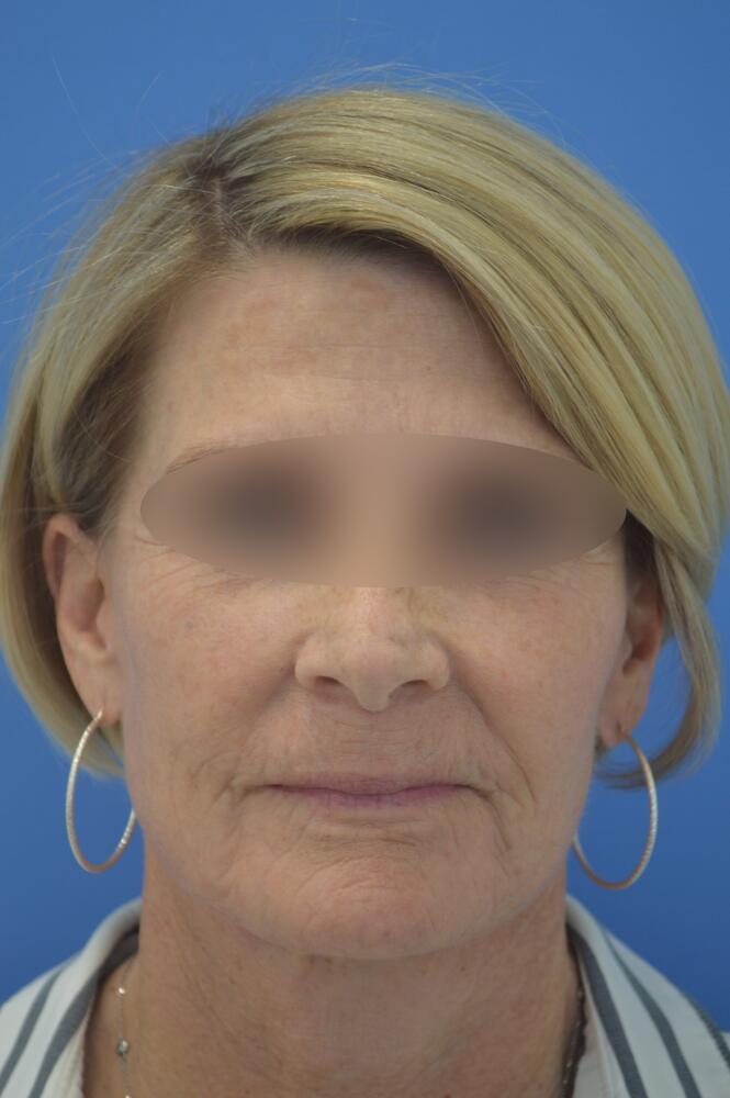 Face and neck lift Before & After Image