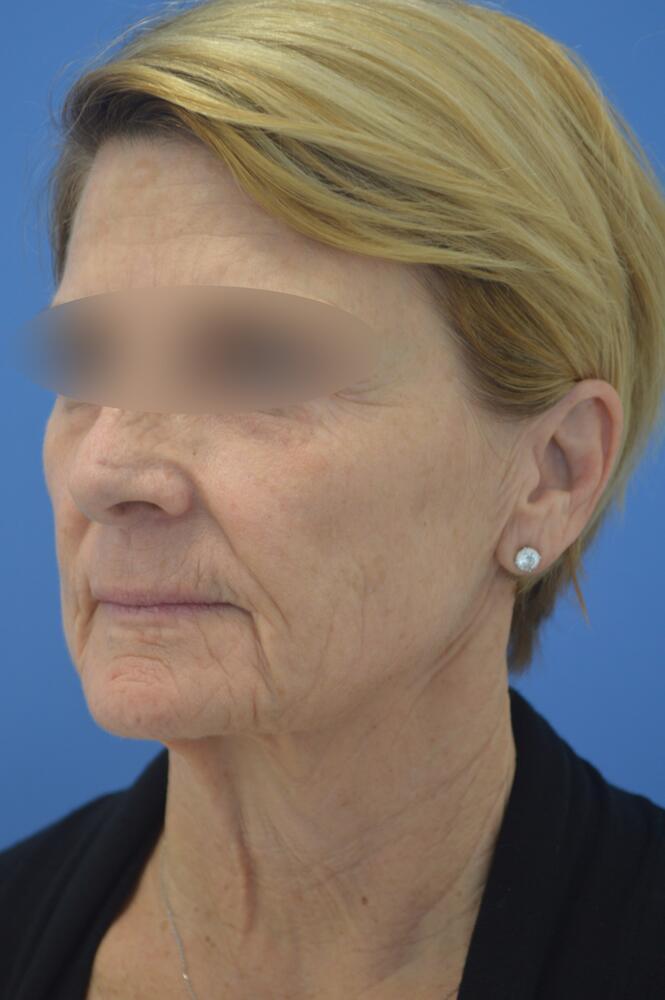 Face and neck lift Before & After Image