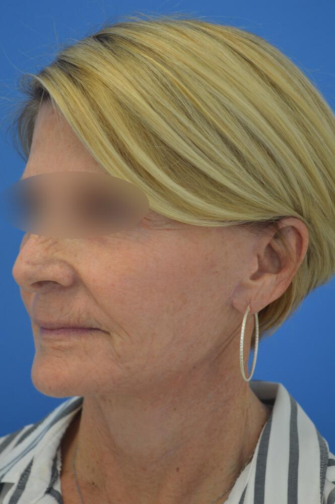 Face and neck lift Before & After Image