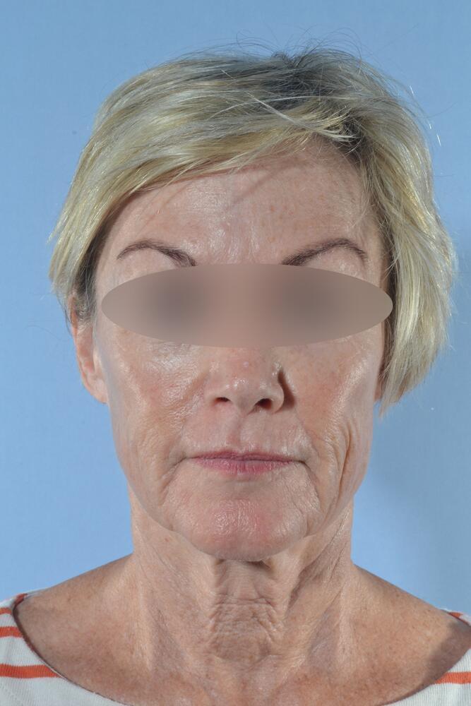 Face and neck lift Before & After Image
