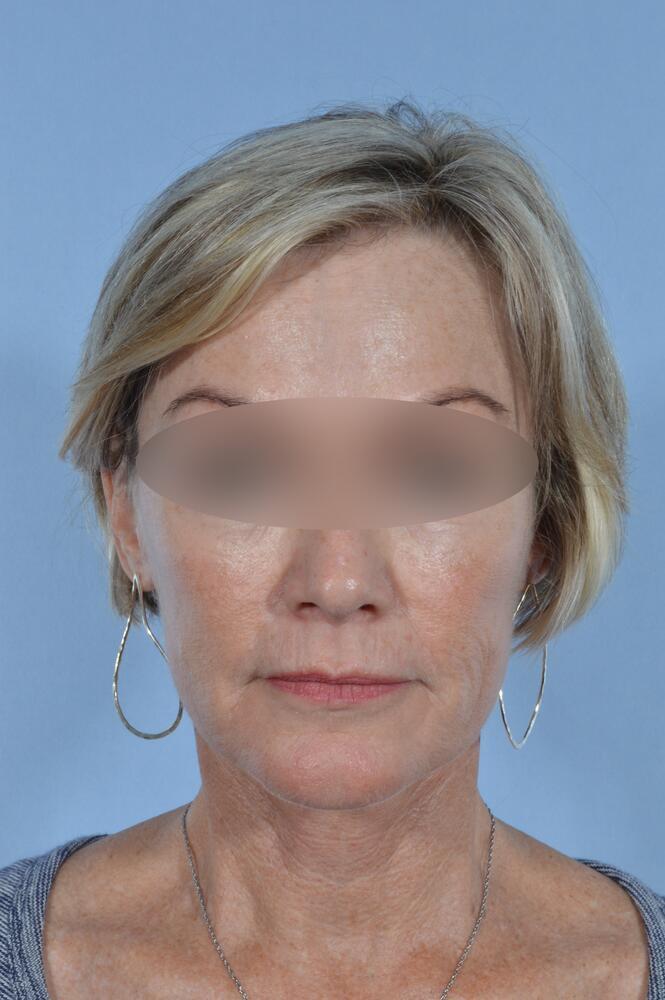 Face and neck lift Before & After Image