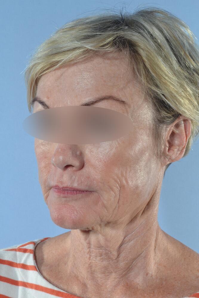 Face and neck lift Before & After Image