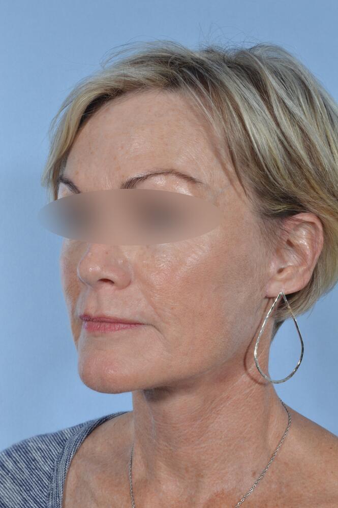 Face and neck lift Before & After Image