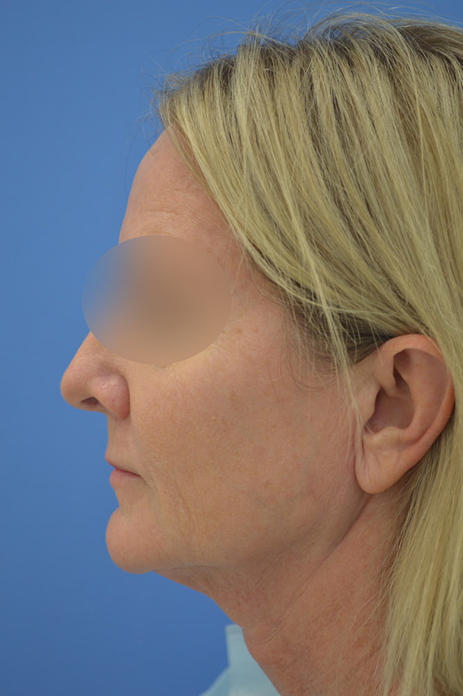 Face and neck lift Before & After Image