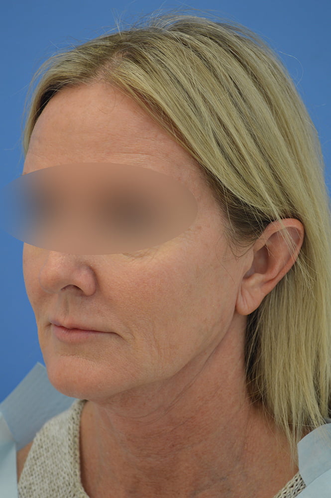 Face and neck lift Before & After Image