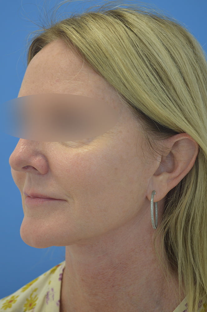 Face and neck lift Before & After Image