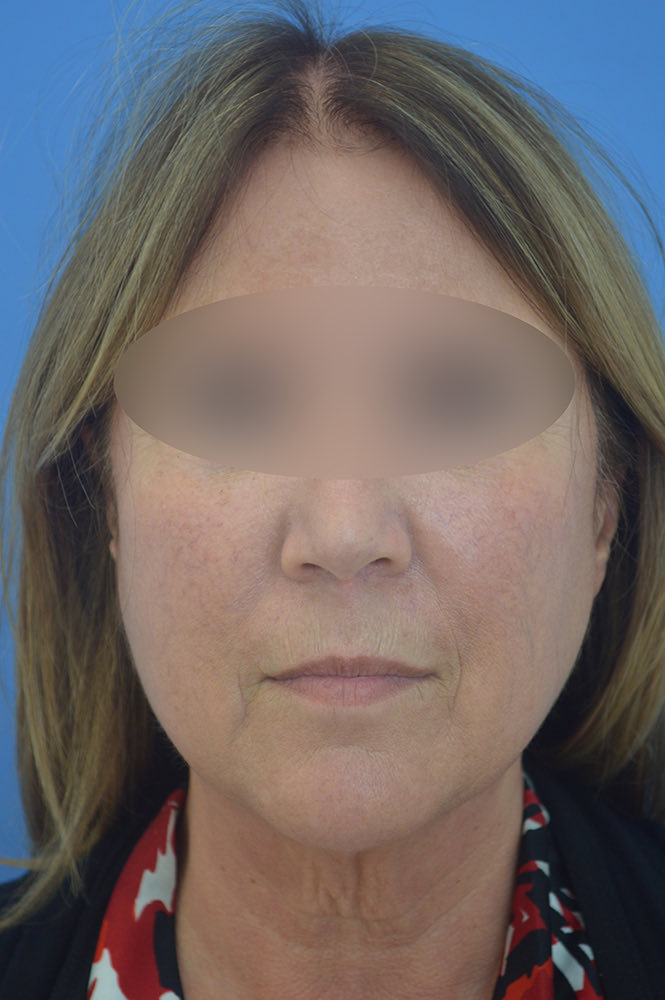 Face and neck lift Before & After Image