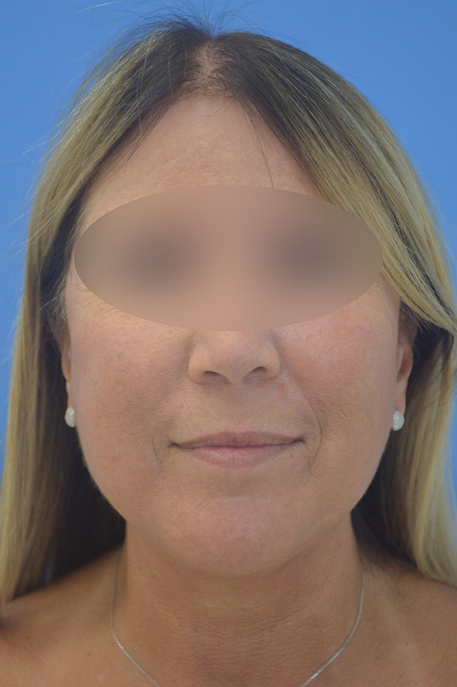 Face and neck lift Before & After Image