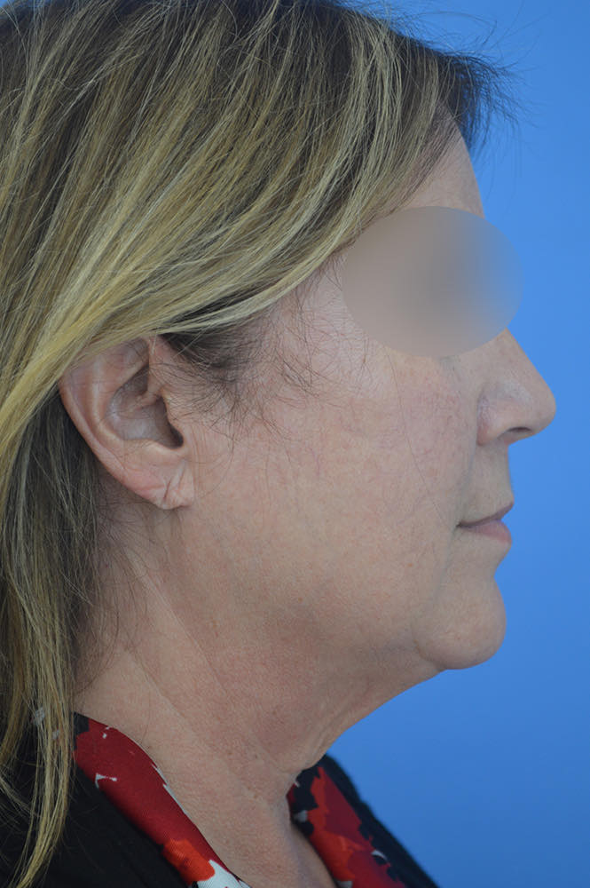 Face and neck lift Before & After Image