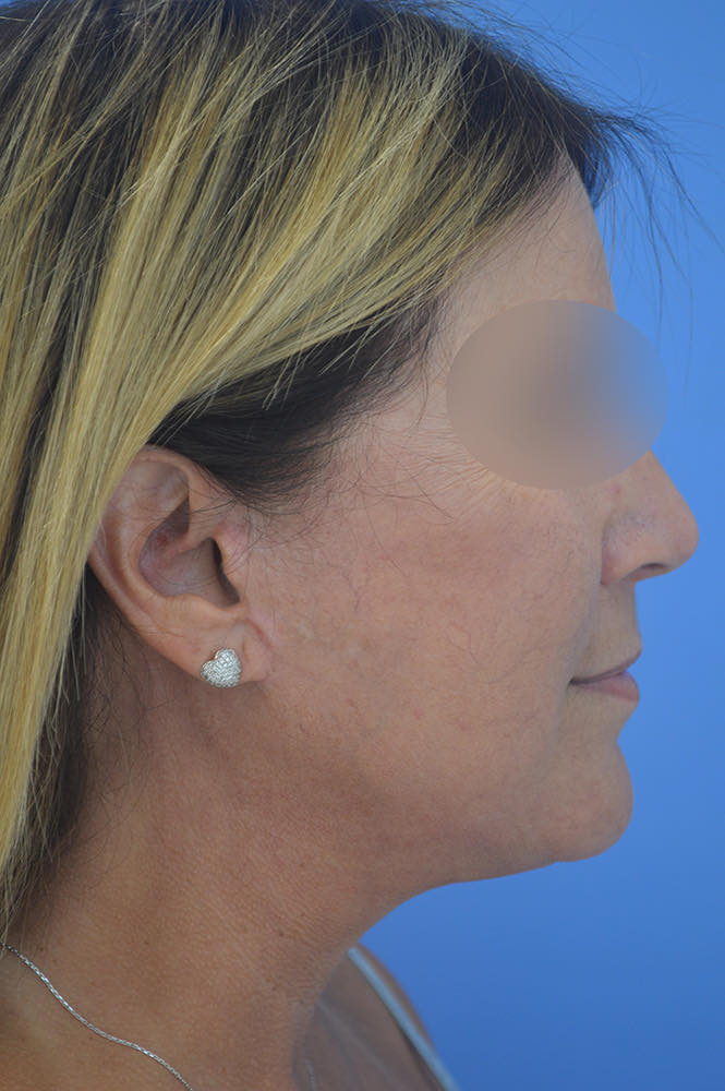 Face and neck lift Before & After Image