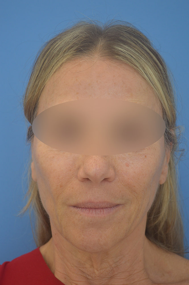 Face and neck lift Before & After Image