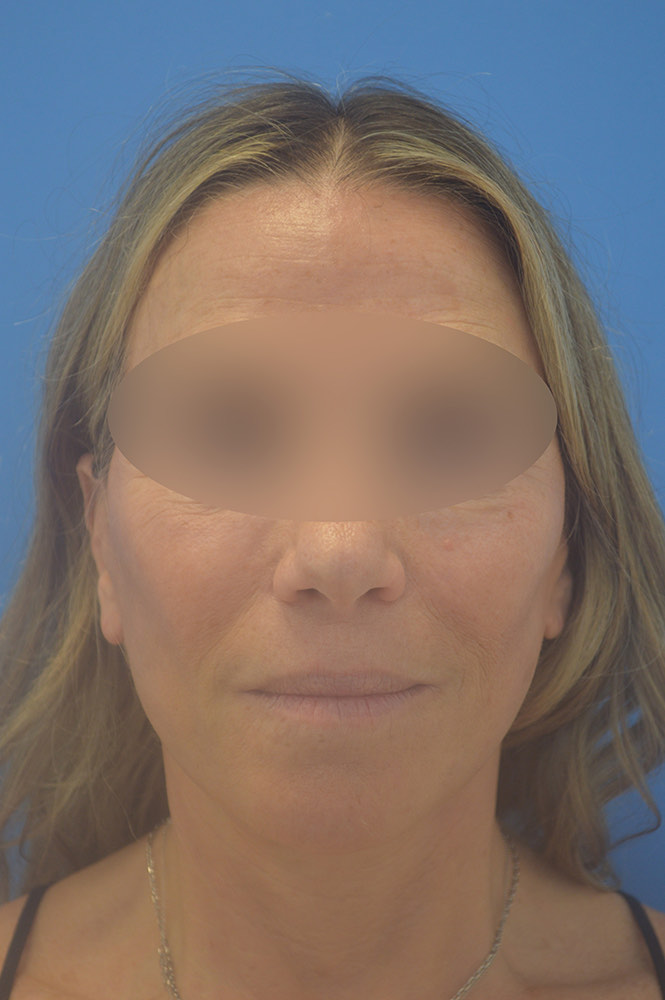Face and neck lift Before & After Image
