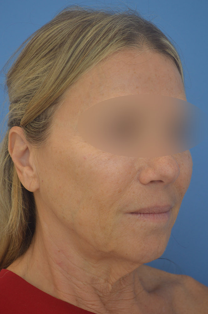 Face and neck lift Before & After Image