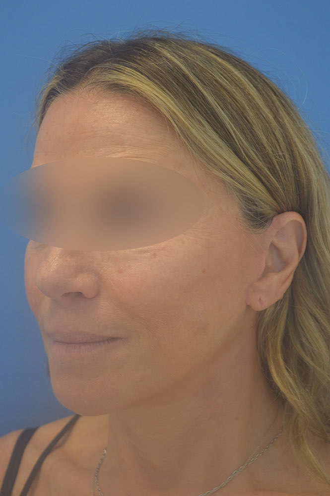 Face and neck lift Before & After Image