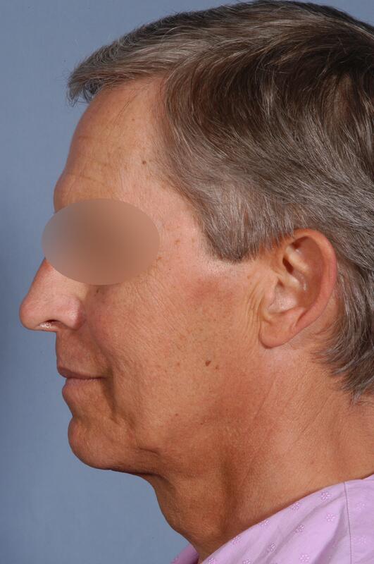 Male facelift Before & After Image