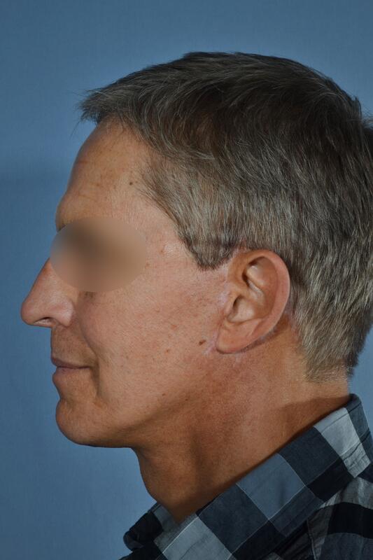 Male facelift Before & After Image